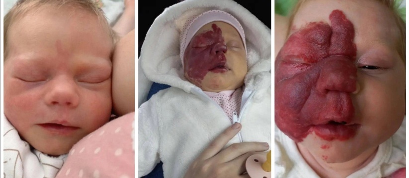 Половина лица девочки покраснела и опухла настолько, что перестал открываться глазик: за жизнь малышки из Краснодарского края с диагнозом гемангиома борются московские врачи