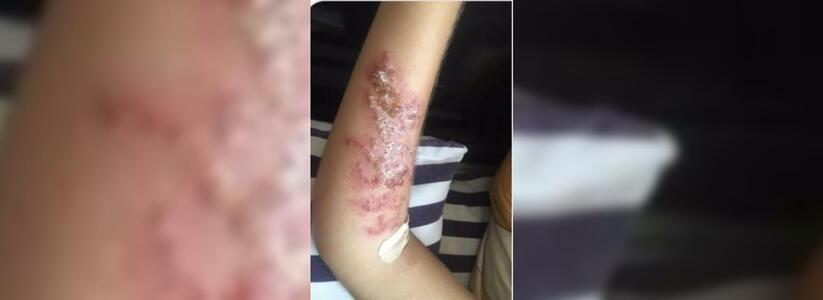 В Анапе 11-летний мальчик получил ожог кожи от временной тату