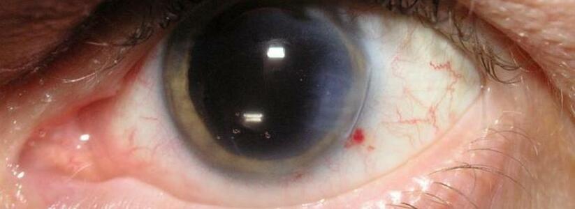 Что такое катаракта и как ее лечить?