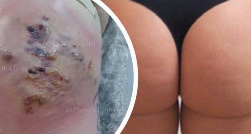 «Теперь там зияет дыра, и нужна пересадка кожи!» Косметолог из Новороссийска изуродовала «пятую точку» пациентки филлерами