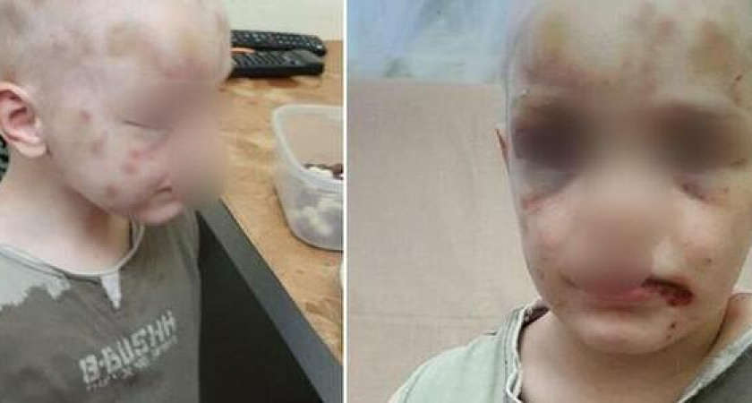 СК возбудил уголовное дело против матери, которая истязала  ребенка в Новороссийске