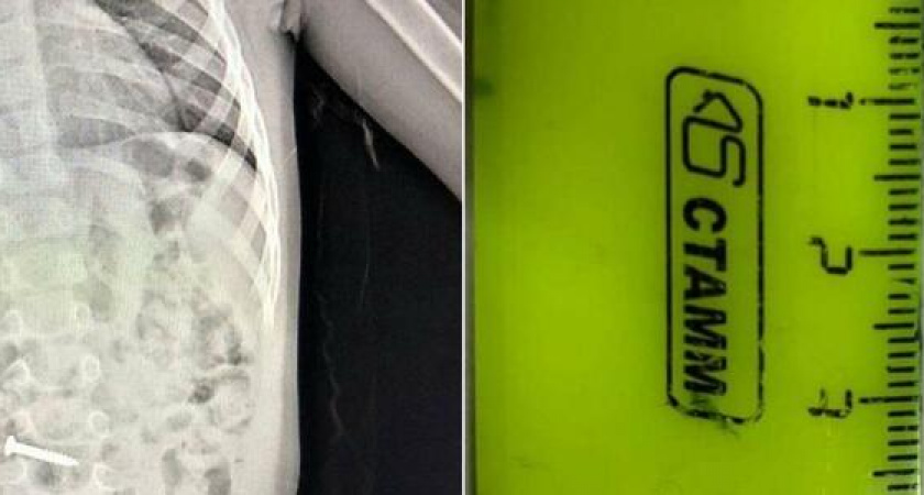 Достали саморез из кишечника двухлетнего ребенка: новороссийские врачи провели сложнейшую операцию