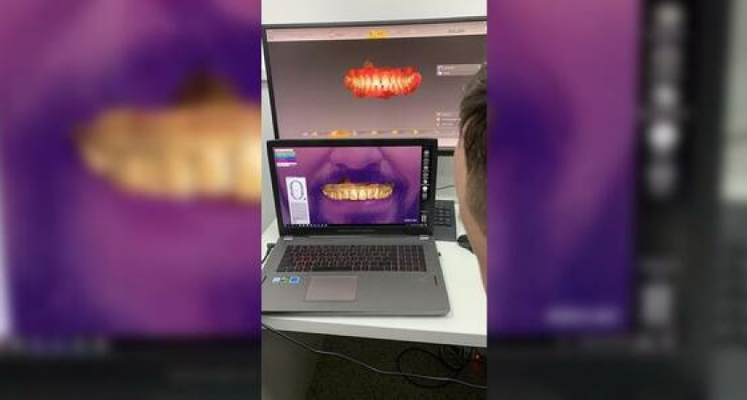 Безметалловая коронка — в два раза дешевле: стоматология «КАВО» приглашает воспользоваться спецпредложением марта