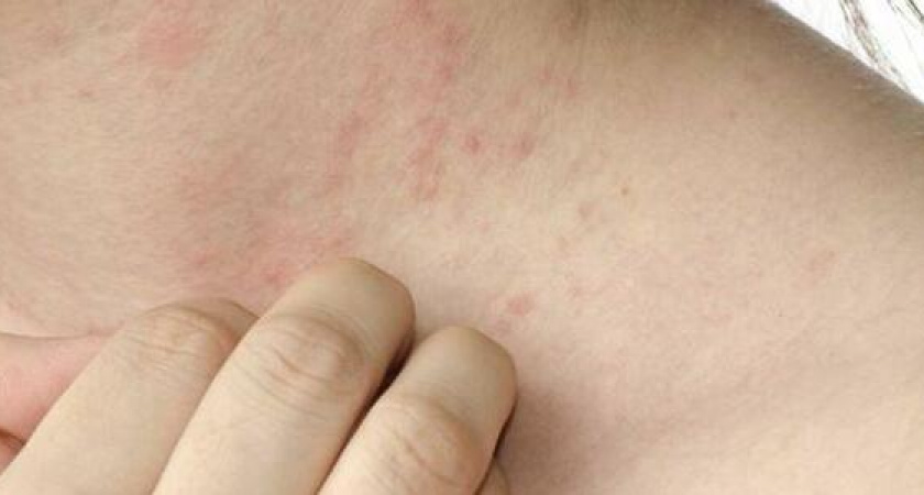 В Роспотребнадзоре рассказали о необычном симптоме "омикрона"