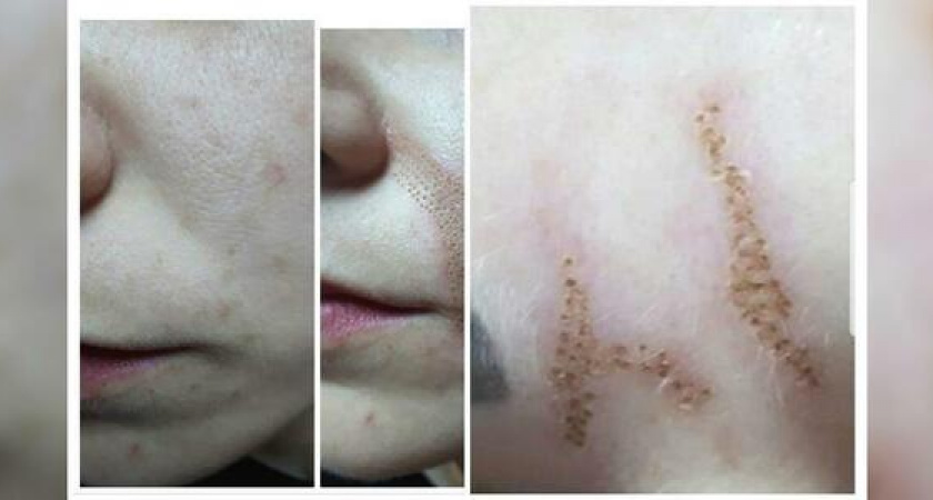 В Новороссийске косметолог изуродовал лицо клиентки: после процедуры по омоложению на коже девушки остались заметные рубцы