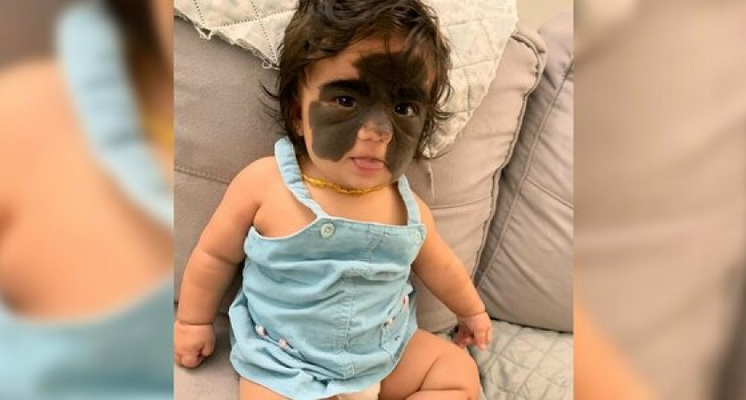 Девочку из США везут в Краснодар, чтобы избавить от «маски Бэтмена»