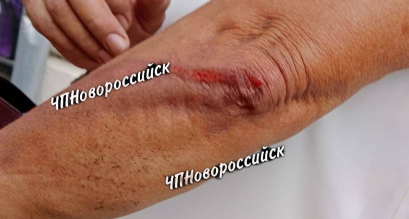 В центре Новороссийска женщина пострадала из-за незакрепленной решетки ливневки