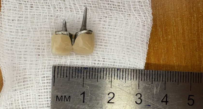 Житель Новороссийска проглотил зубной имплант вместе со штифтами