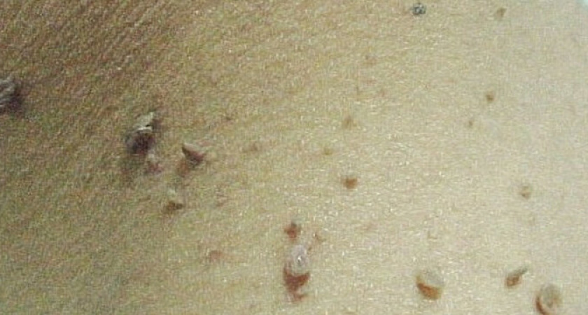 Папилломы отвалятся мигом: нужно всего лишь это средство